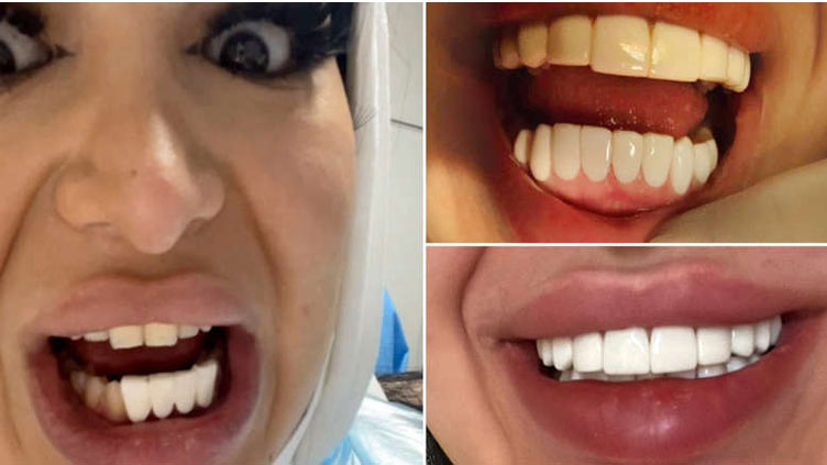 Woman left with 'piano key' teeth after botched procedure